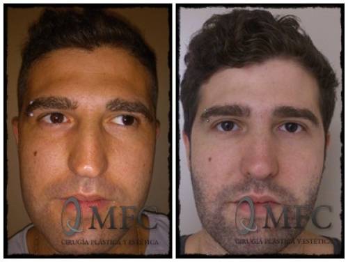 Rinoplastia